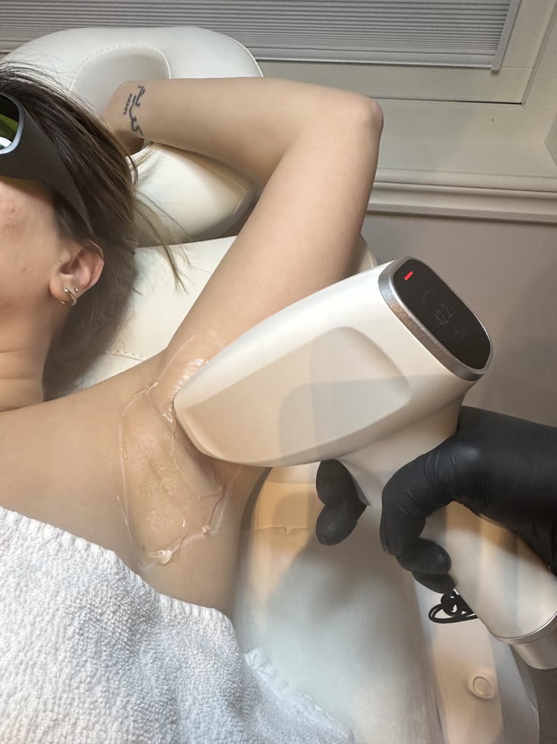 Laserbehandling av armhåla