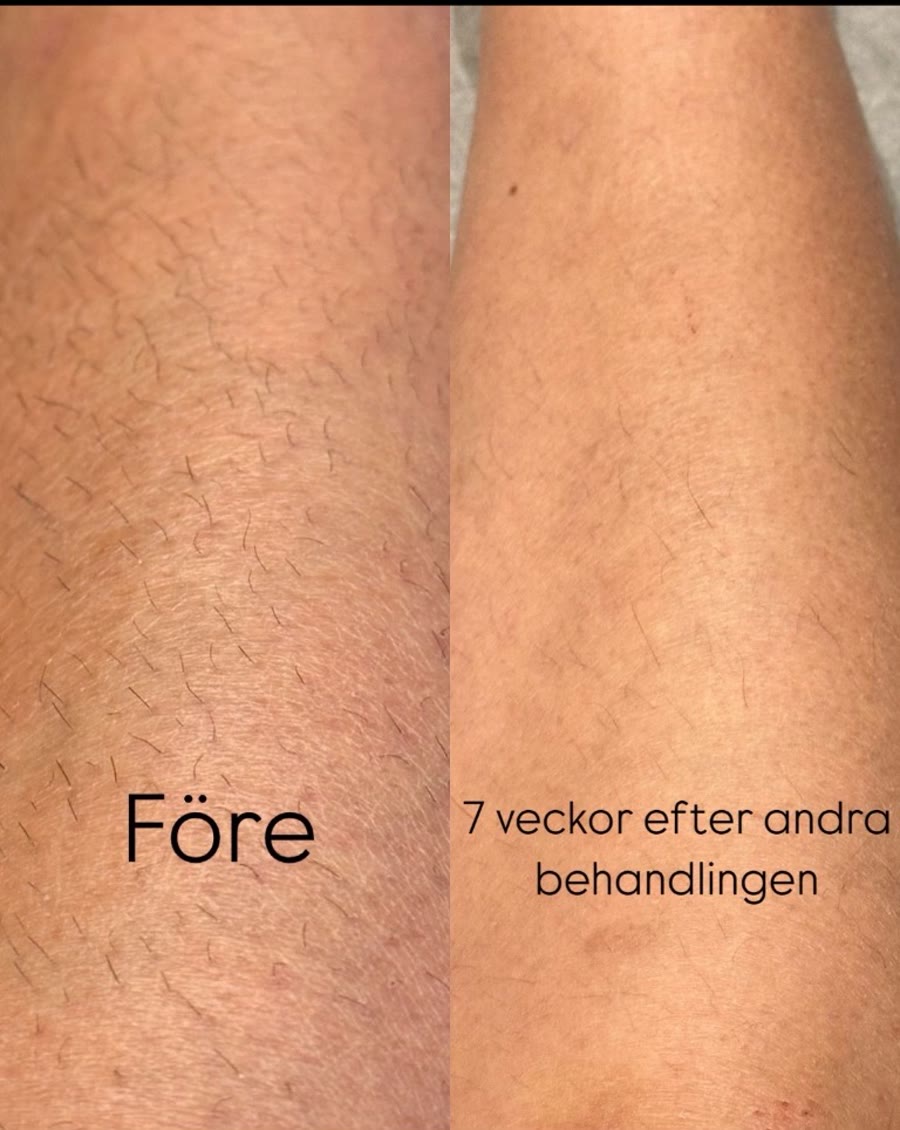 Före och efter laserhårborttagning hos KLINIK 17